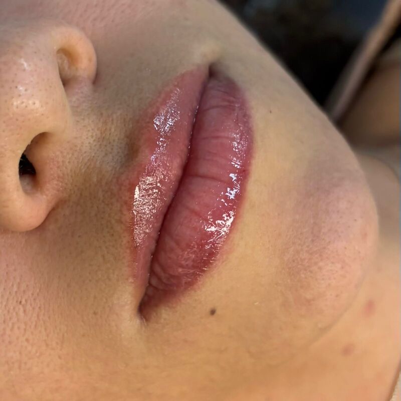 Foto do procedimento de Nutrigloss